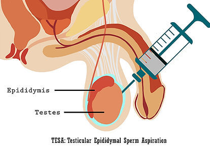 Types of biopsy: TESA