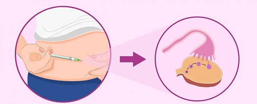 איך מבצעים IVF?